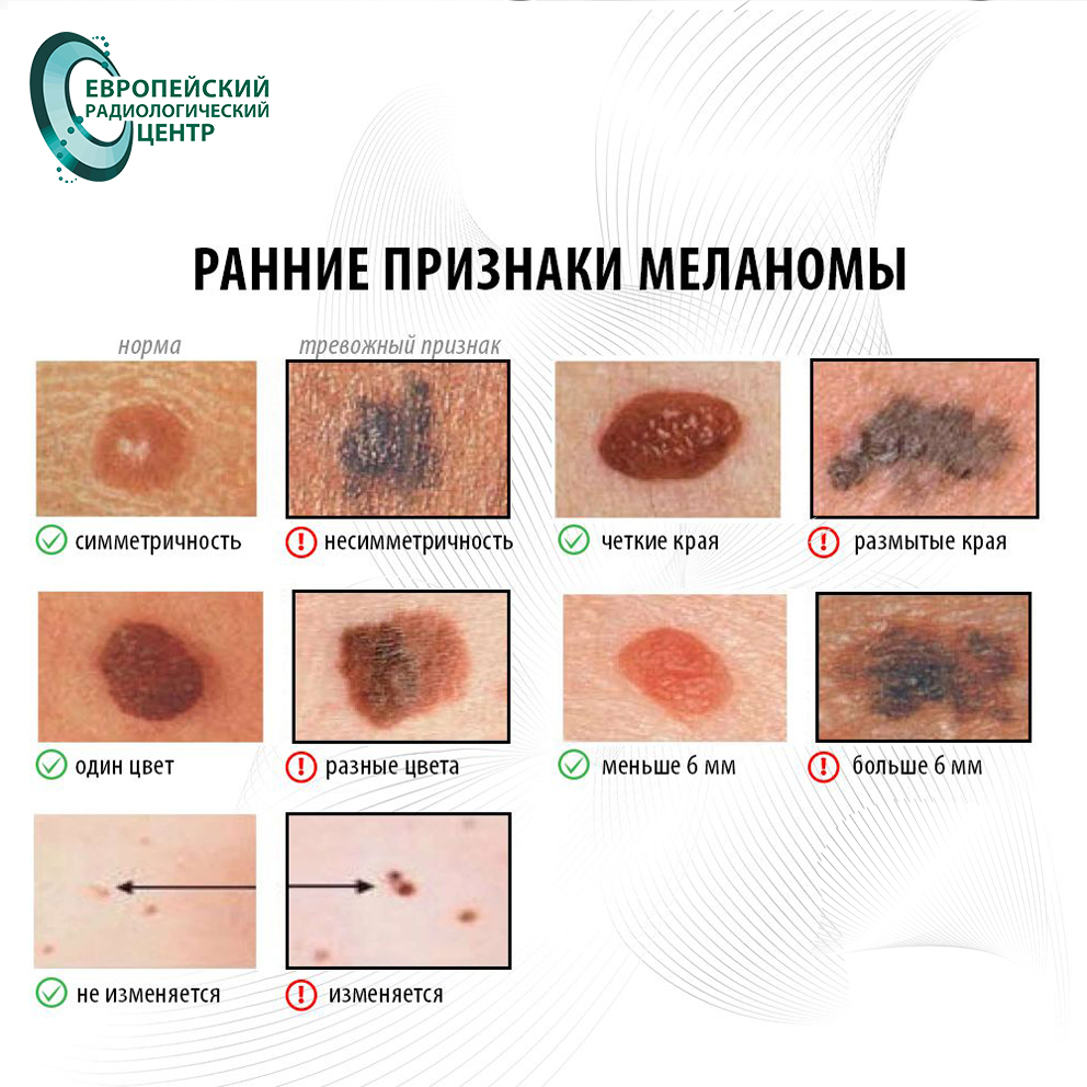 Кожные новообразования — новости ЕРЦ