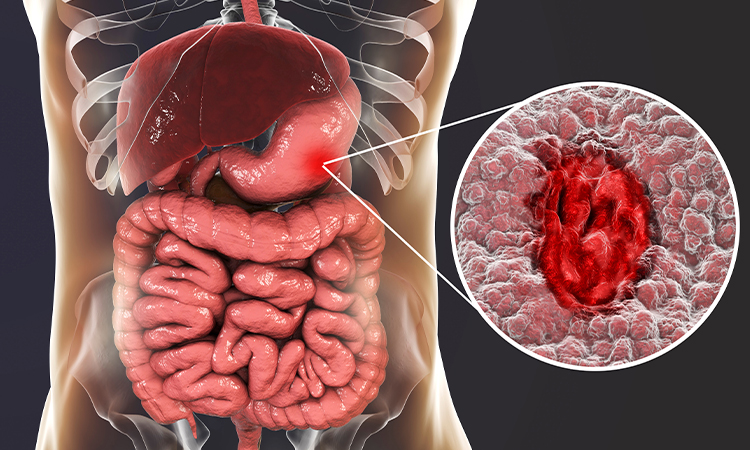 виразка шлунка