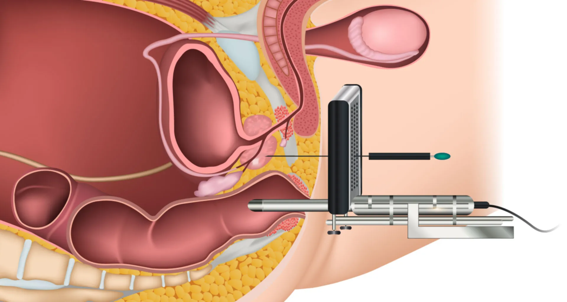 как делают биопсию простаты