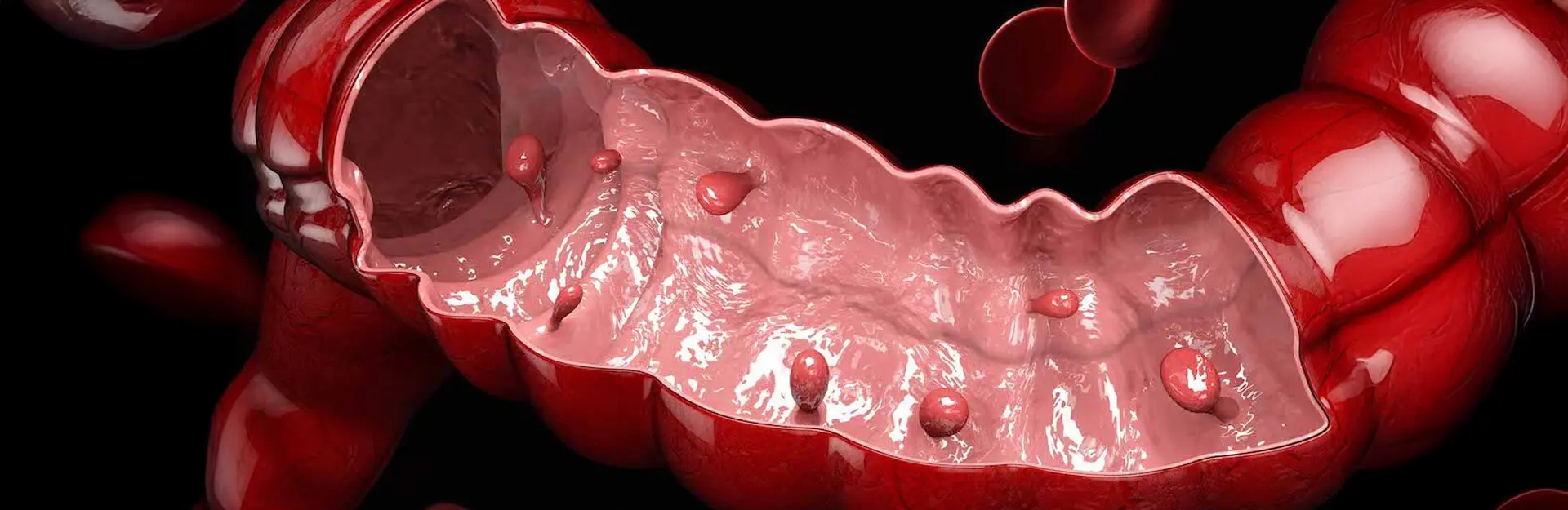 Что такое полипы кишечника