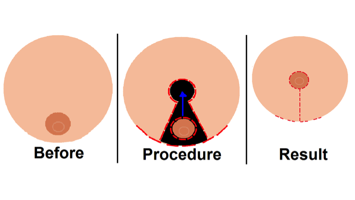 реконструктивная пластика груди (маммопластика)