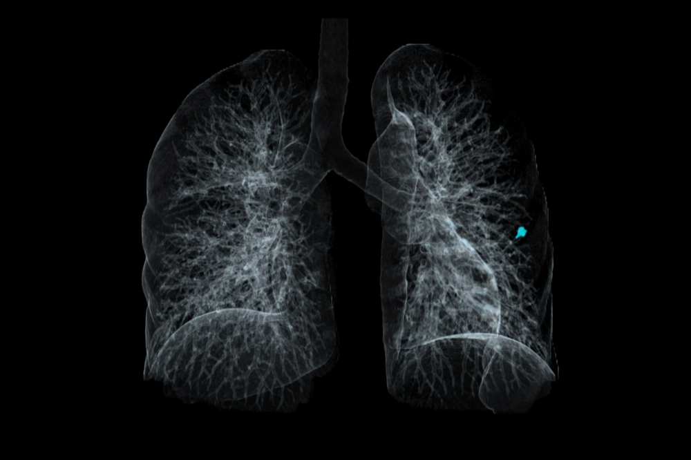 возможности КТ в исследовании грудной клетки