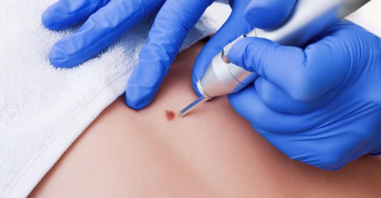 удаление раковых опухолей