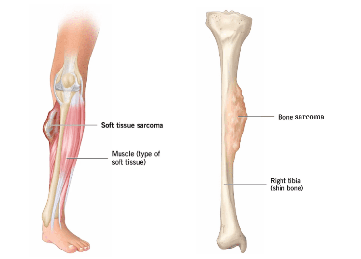 Симптомы саркомы
