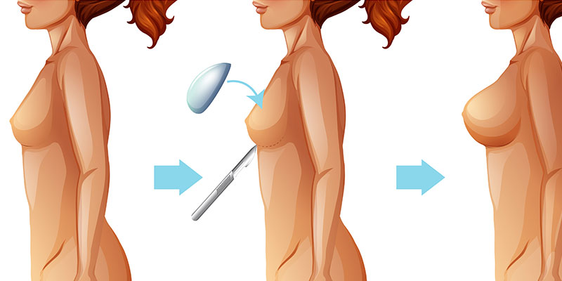 що таке аугментаційна мамопластика