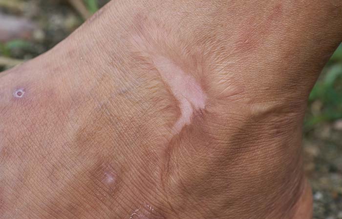 послеожоговые и посттравматические рубцы