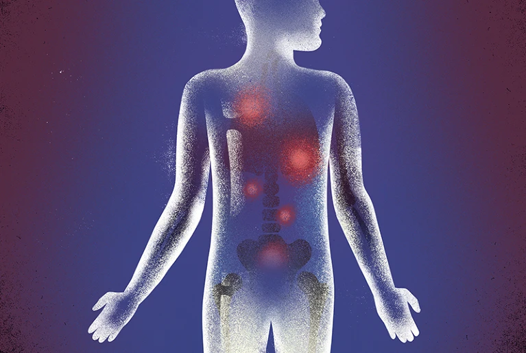 метастазы рака простаты