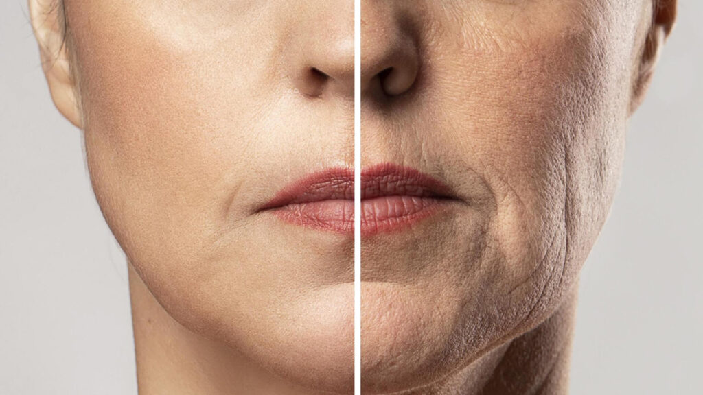 подтяжка нижней трети лица