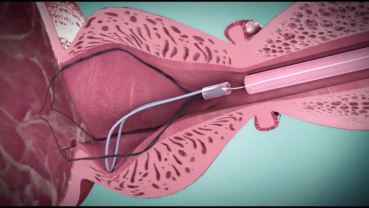 операція при аденомі простати