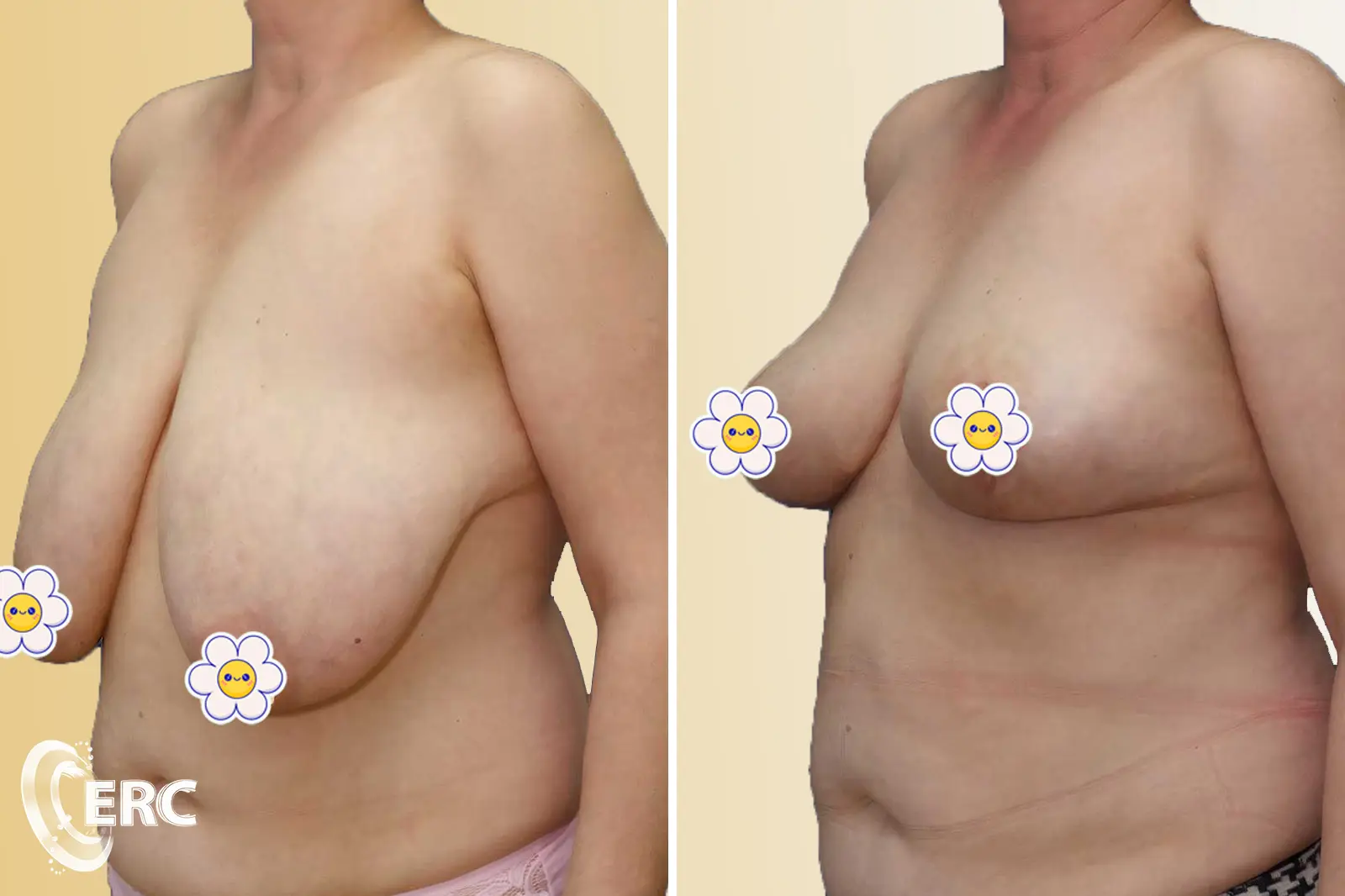 Редукційна мамопластика (зменшення грудей)