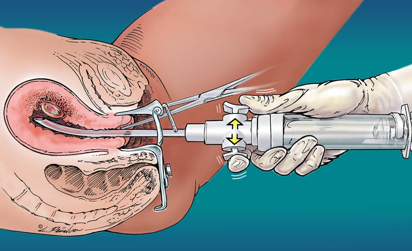 Показання до біопсії шийки матки