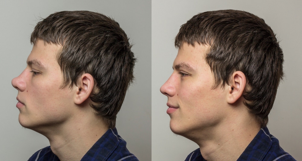 ринопластика для мужчин