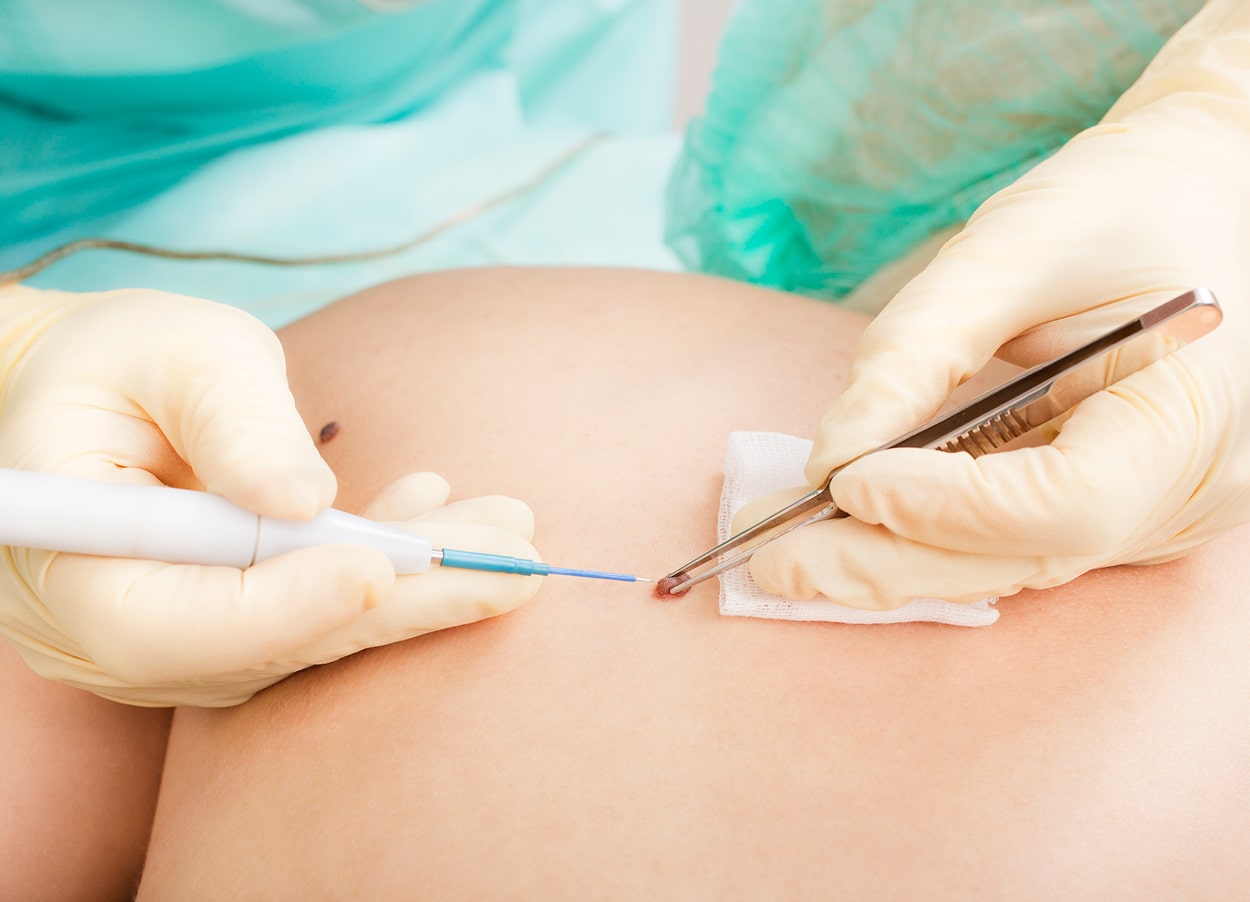 Видалення новоутворень шкіри