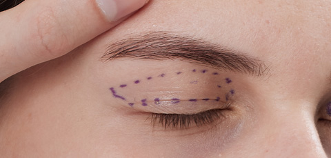 как проводится блефаропластика