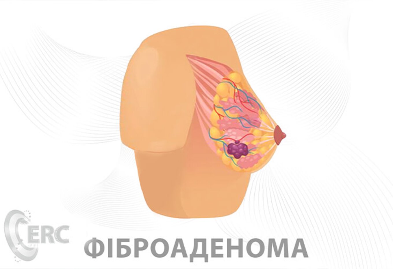 Симптомы фиброаденомы и способы её лечения — медицинские статьи Европейского Радиологического Центра